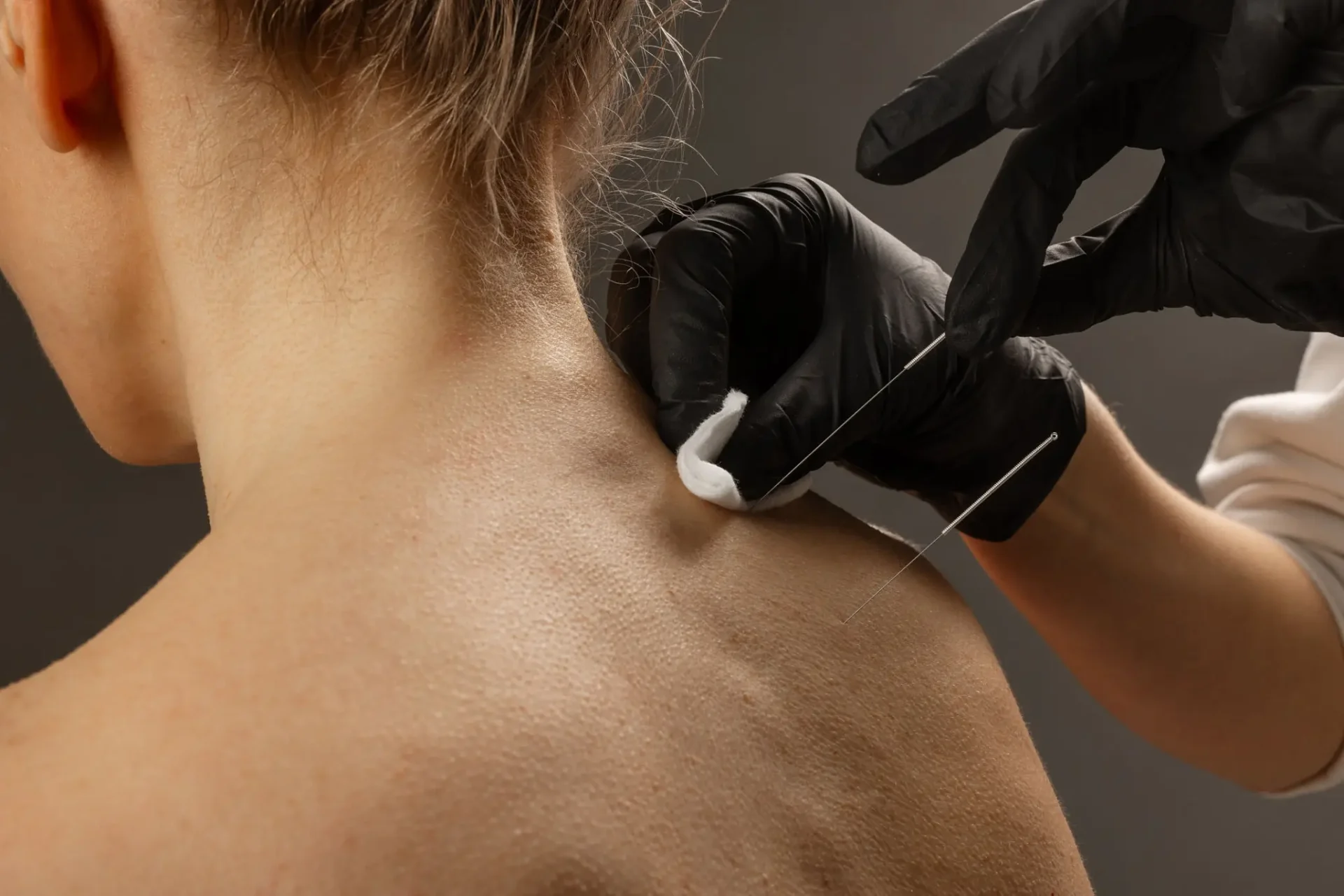 Therapist performing acupuncture on shoulder